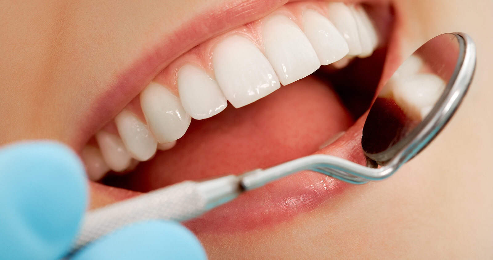 Effective Teeth Whitening in Overland Park KS